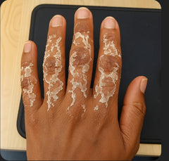 Knuckles serum